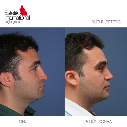 fotos antes y después de nuestros pacientes 9